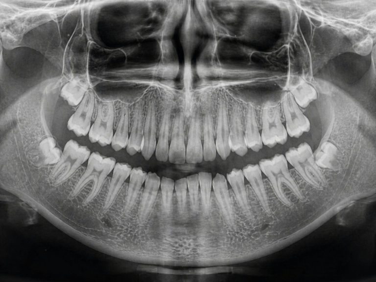 Full mouth dental xray